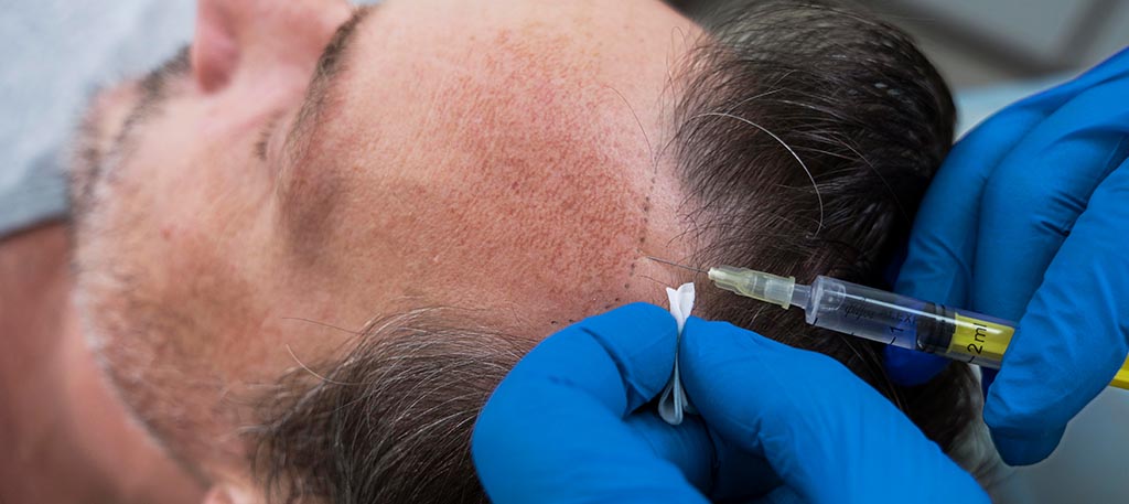 Hair Transplant