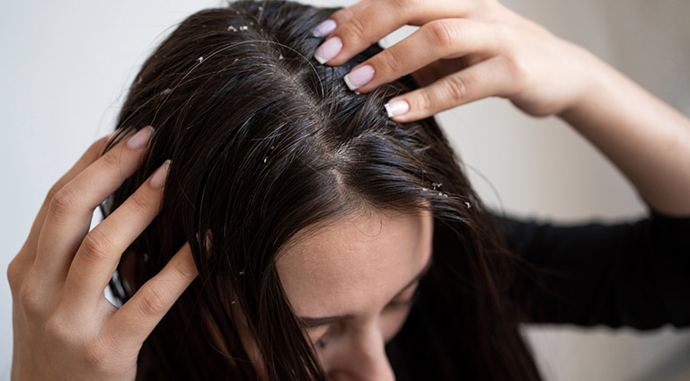 Understanding Dandruff: Causes and Symptoms